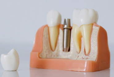 سه دلیل برای انتخاب ایمپلنت دندان