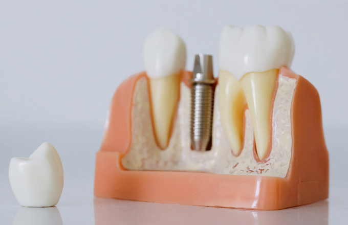 سه دلیل برای انتخاب ایمپلنت دندان