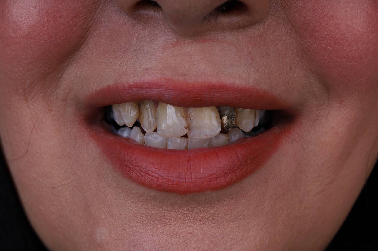 ایمپلنت اقساطی ۳۶ ماهه در تهران