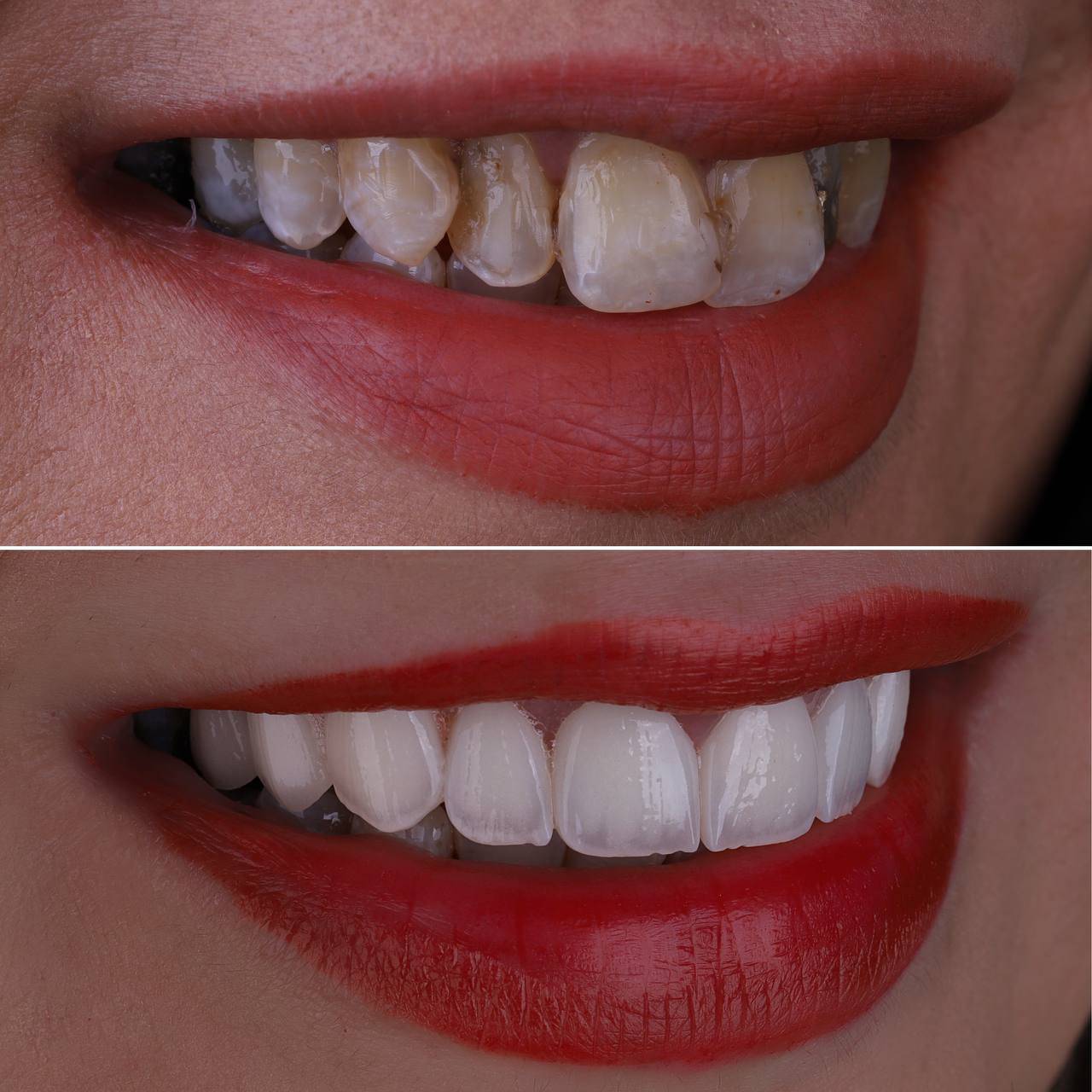 ایمپلنت اقساطی ۳۶ ماهه در تهران