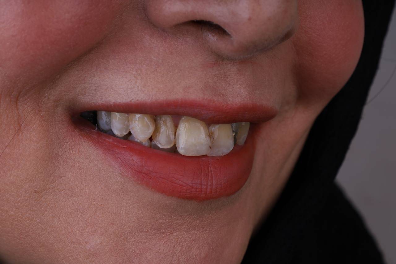 ایمپلنت اقساطی ۳۶ ماهه در تهران