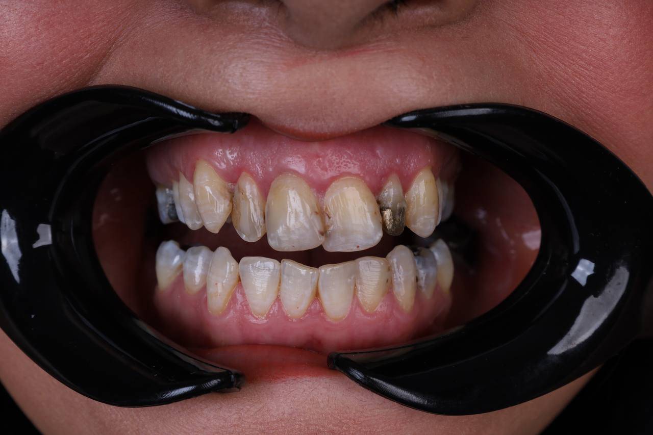 ایمپلنت اقساطی ۳۶ ماهه در تهران