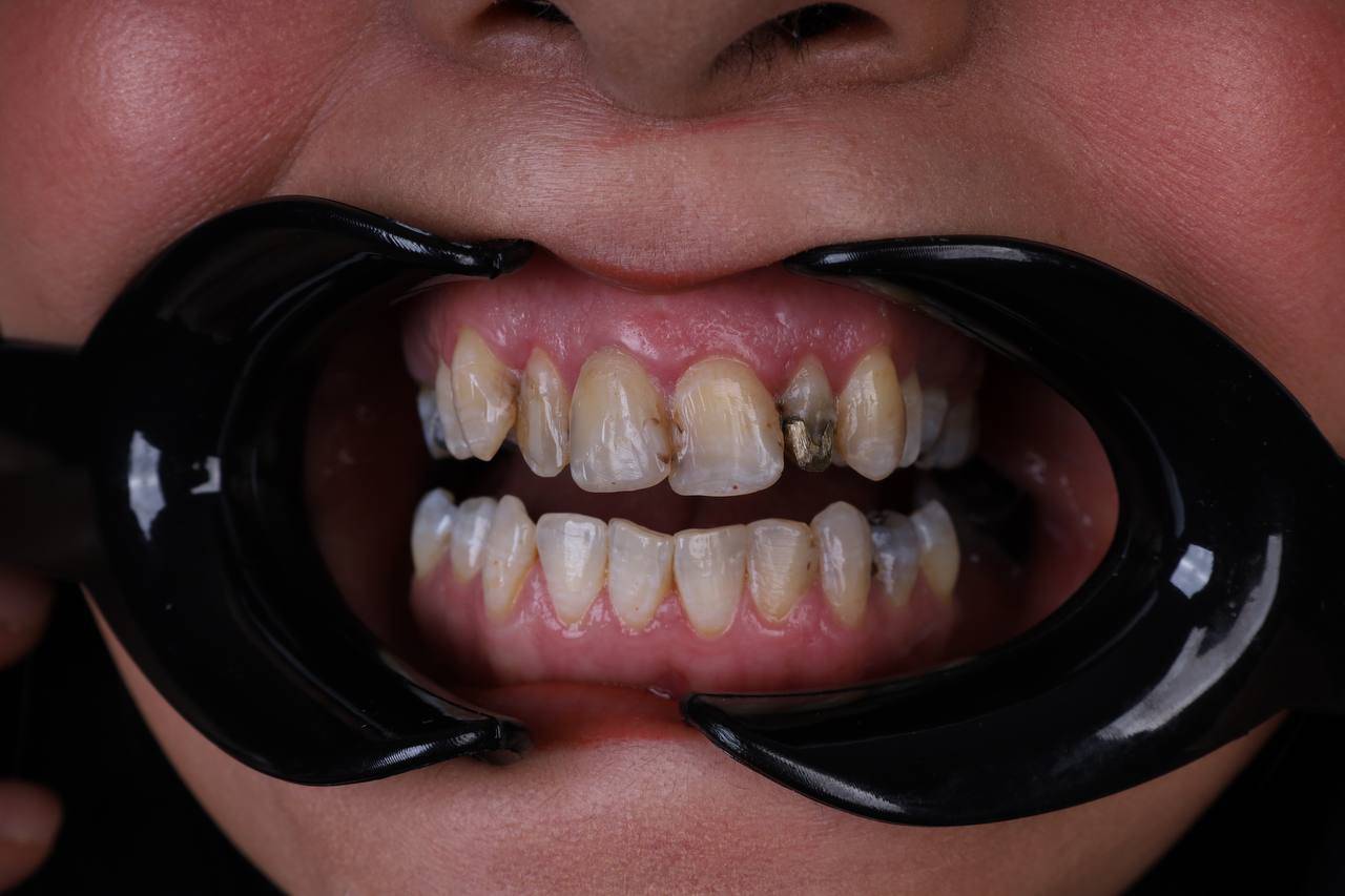 ایمپلنت اقساطی ۳۶ ماهه در تهران